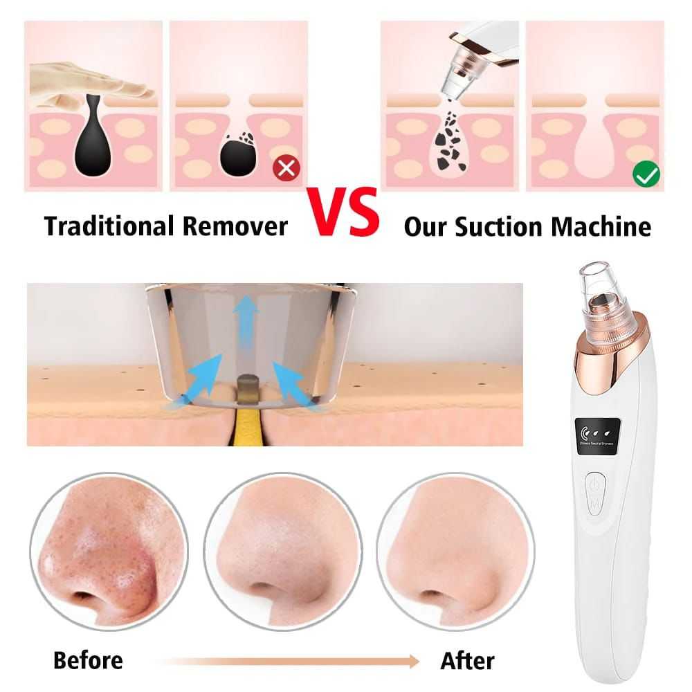 PoreVac Blackhead Remover